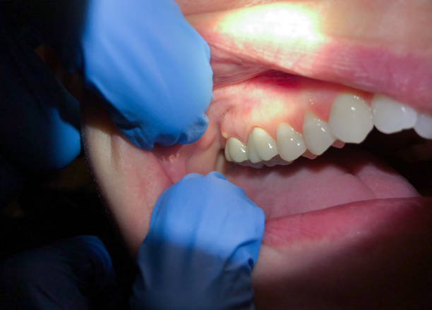 Best Emergency Treatment for Oral Infections in Excelsior, MN